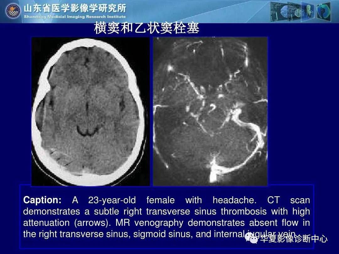 诊断|缺血性脑血管病的影像诊断