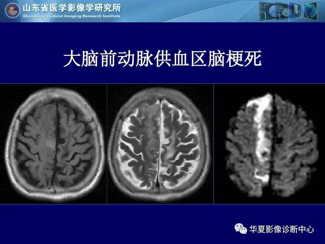 诊断|缺血性脑血管病的影像诊断