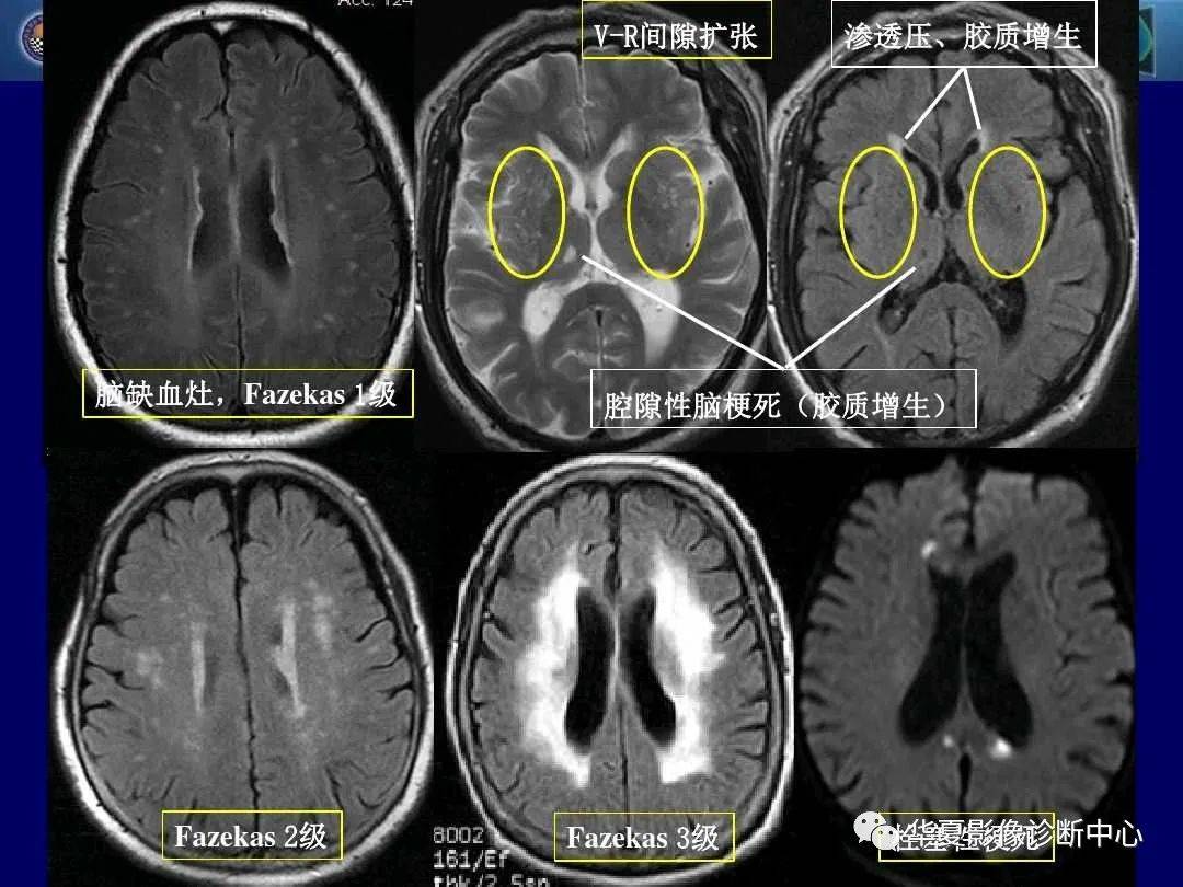 诊断|缺血性脑血管病的影像诊断