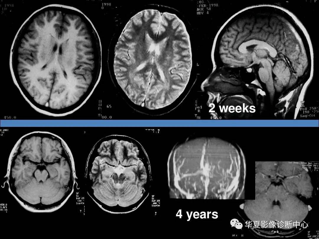 诊断|缺血性脑血管病的影像诊断