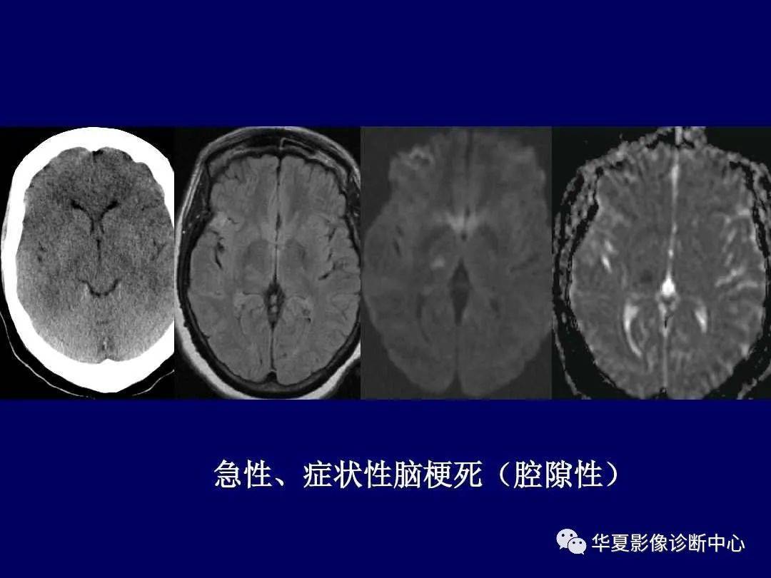 诊断|缺血性脑血管病的影像诊断