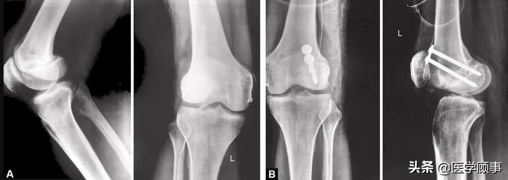 5 a～b(a)35歲男性患者,letenneurⅢ型股骨外側髁hoffa骨塊,傷後4個月