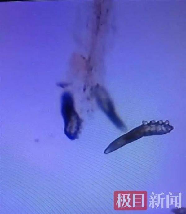 肖泽锋|女子眼睛痒，一查睫毛上竟有20只虫子，还不停地蠕动