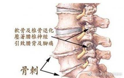 关节|骨质疏松与骨质增生有什么区别和联系？