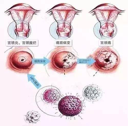 宫颈癌人口_“全国妇幼健康促进公益项目”帮助降低宫颈癌发病率提高我国出