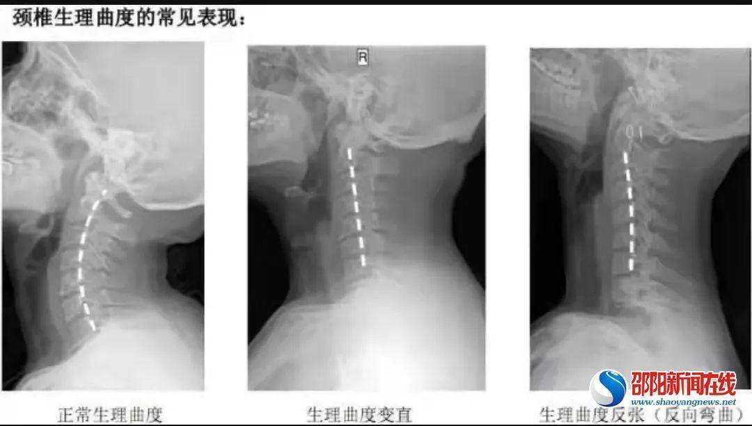 颈椎|才15岁，居然颈椎反弓了！