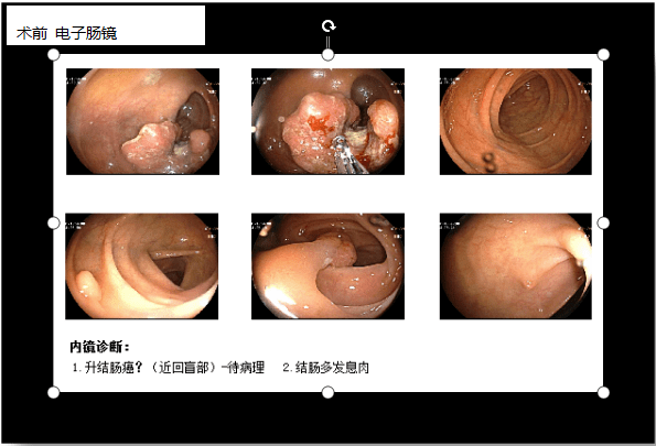 肠镜检查报告单图图片