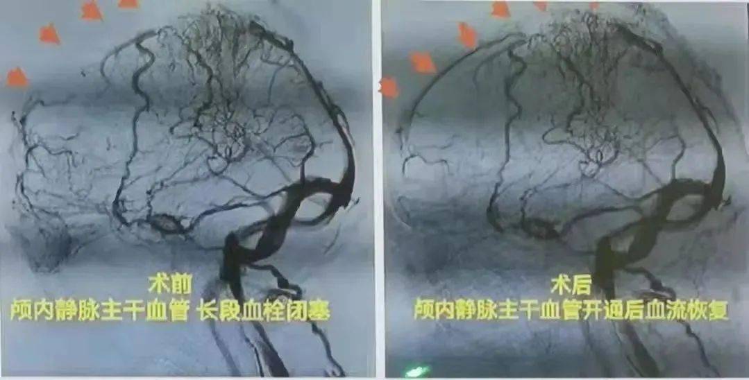 血栓|30岁小伙突然抽搐、昏迷不醒！只因狂喝这个年轻人爱的