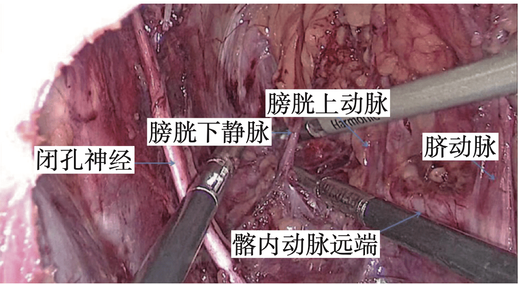 葉凱腹腔鏡直腸癌側方淋巴結清掃解剖與筋膜認識腹腔鏡胃腸手術筆記第