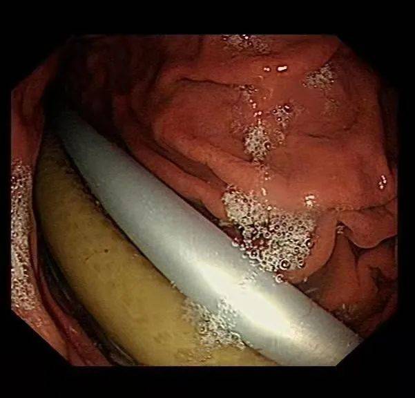 男子|男子胃里取出衣架、塑料管！在肚里待了3个月