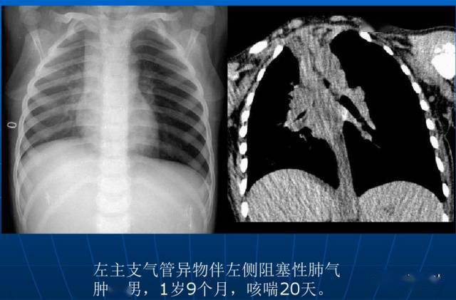 「x线诊断要点」关于"肺气肿"的一些概念,需要熟悉(结合ct)