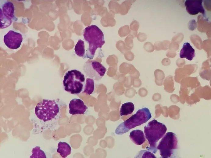 弥漫大B细胞淋巴瘤图片