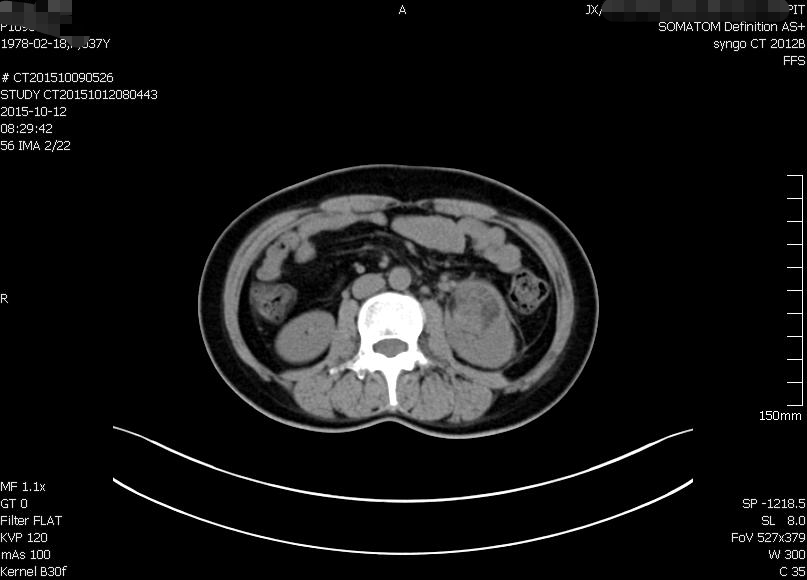 spark病例挑戰第111期6737歲女體檢發現左腎佔位這個ct影像你怎麼