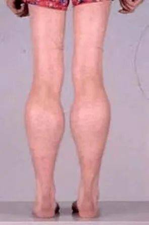 科普|?【积医科普】出现这些症状,当心肌肉疾病