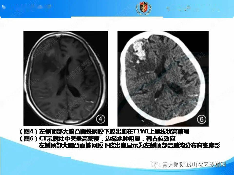 淀粉样变性脑血管病的影像诊断