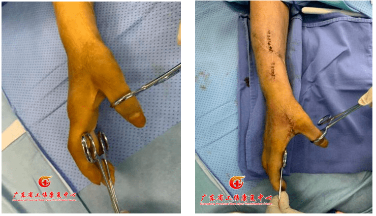 轻度虎口挛缩可以采用虎口成形术,通过虎口周边局部皮瓣的重新排列