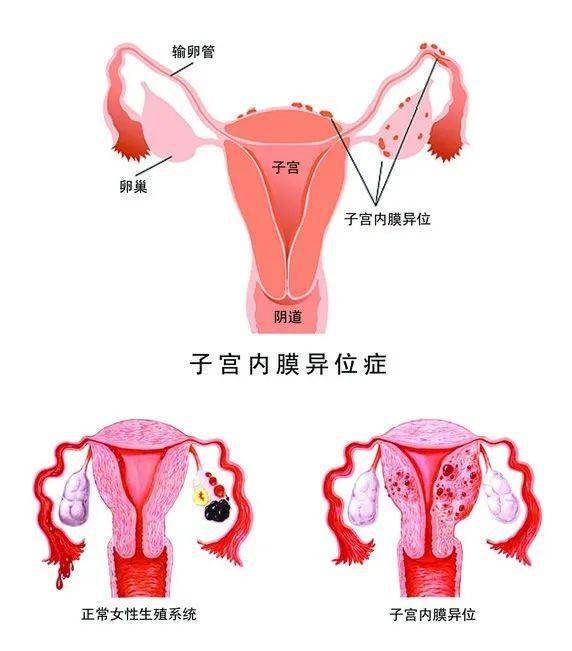 二甲双胍在生殖和妇科中的应用