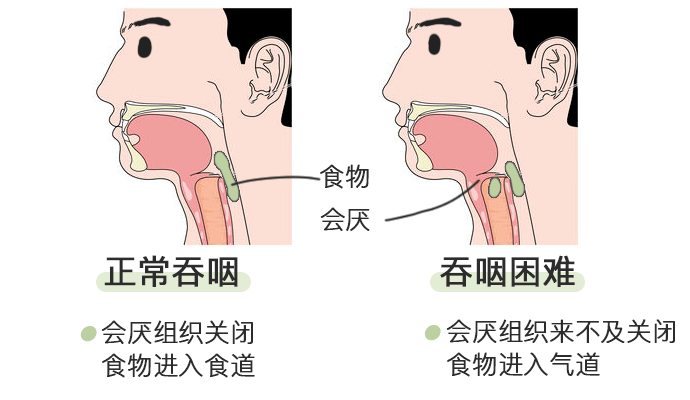 正常吞咽时:会厌则向下,盖住气管,食物或水不会进入气管;●呼吸税话