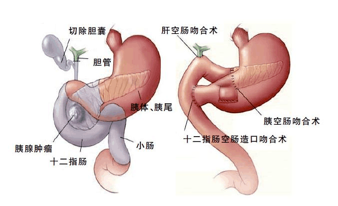 胰十二指肠吻合口图图片