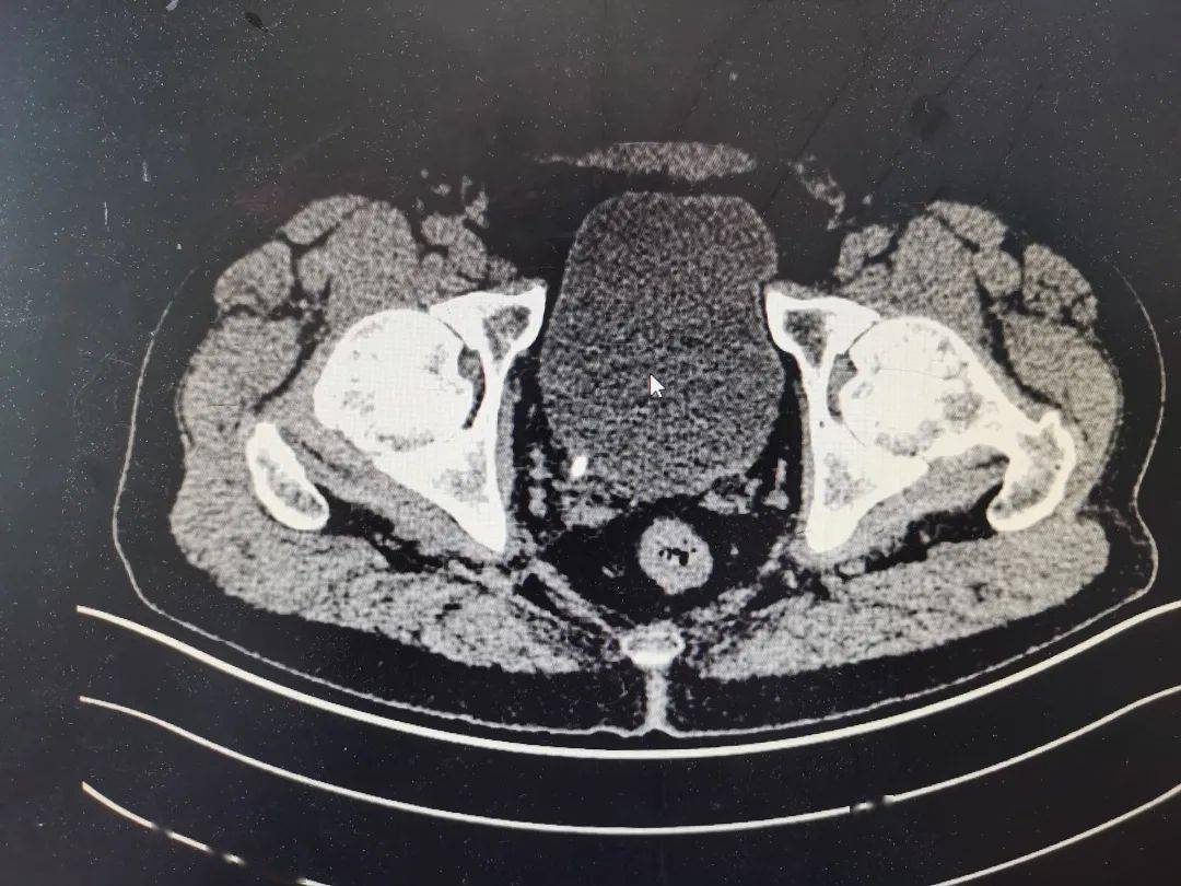 膀胱结石CT图片