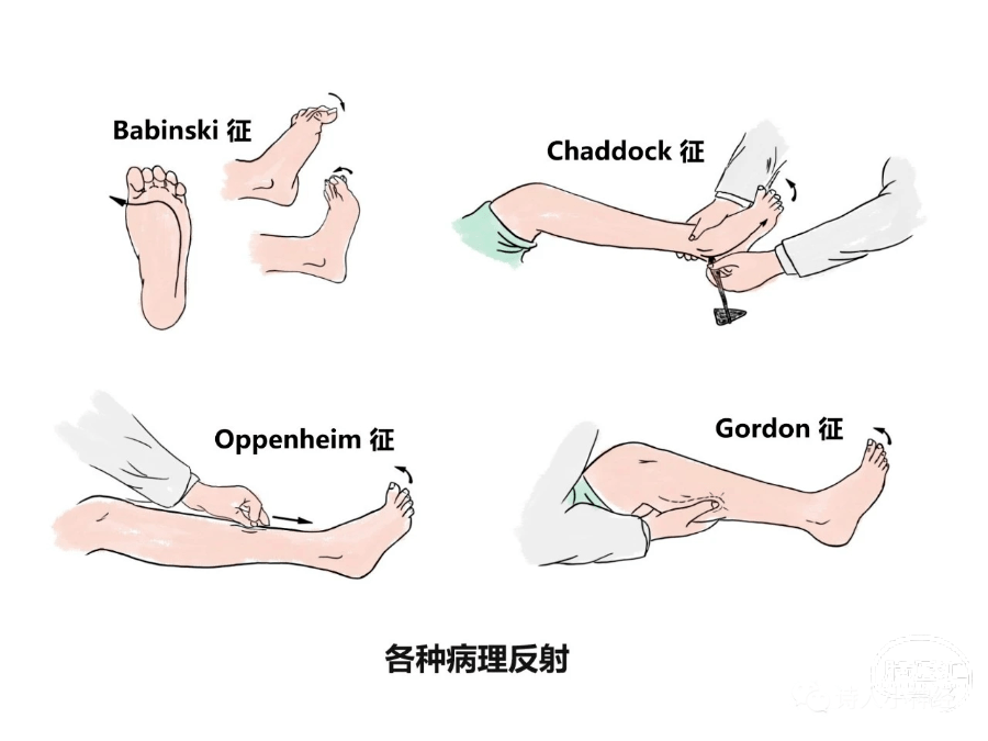 去皮质强直图片