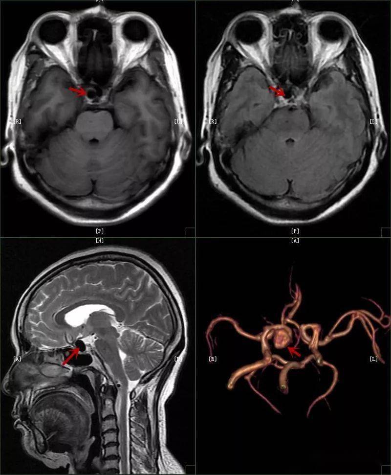 顱內血腫大面積腦梗死腦幹出血2.