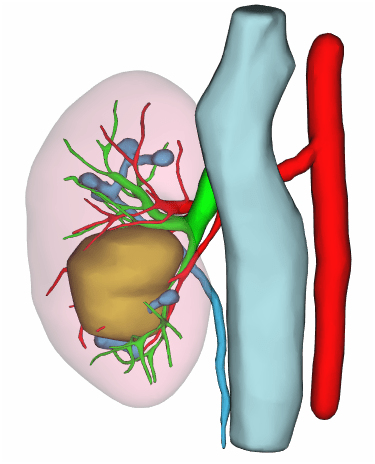 输尿管|做了肾盂旁囊肿手术却没有疤痕,怎么回事?
