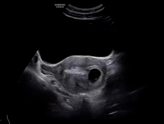 宫角妊娠的超声图像图片