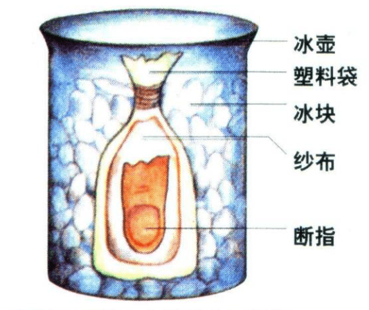 小伙|小伙3指离断19小时千里奔广州，“再植＋再造”成功保指