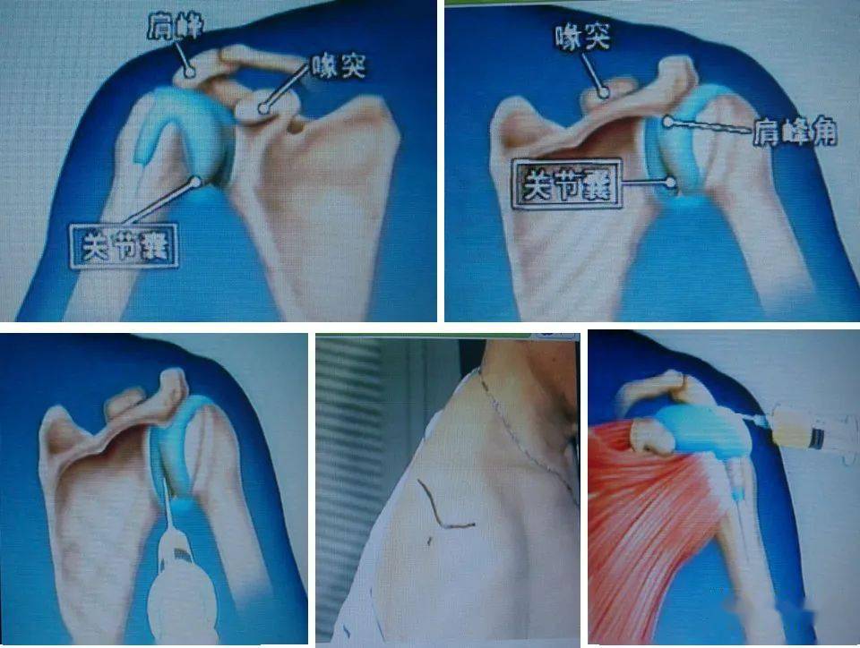 12种关节腔穿刺方法你都掌握了吗