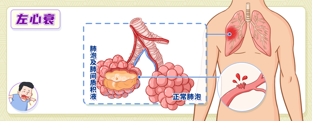 症状|咳嗽、咳痰竟还可能与心脏病、胃病有关？