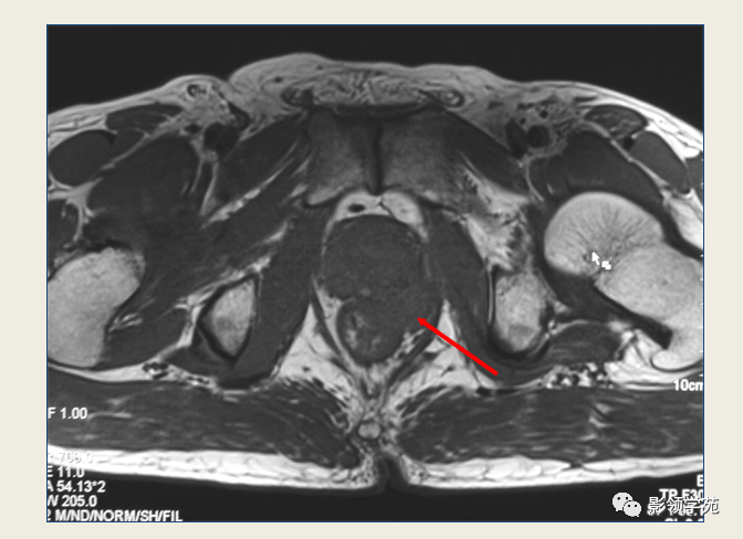 前列腺磁共振图像图片
