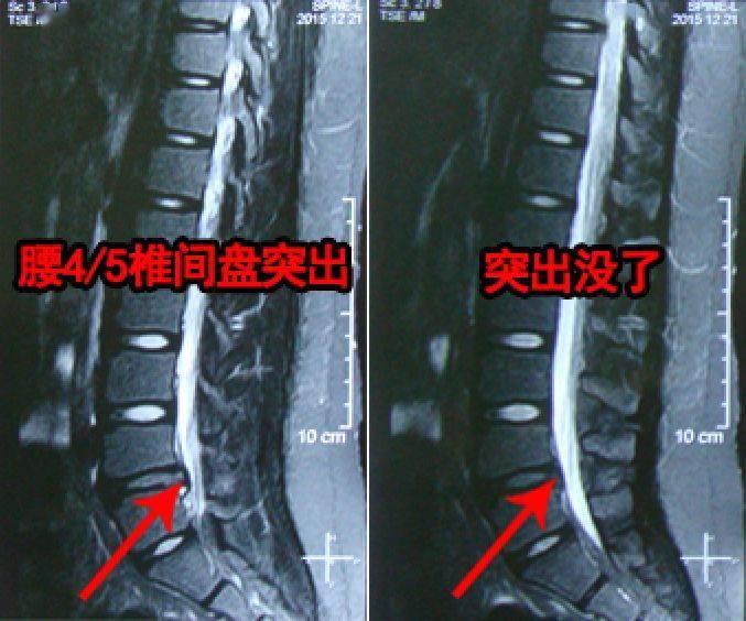 第五腰椎疼痛图片