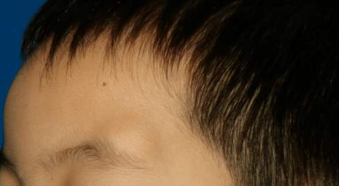 婴儿眉弓囊肿图片图片