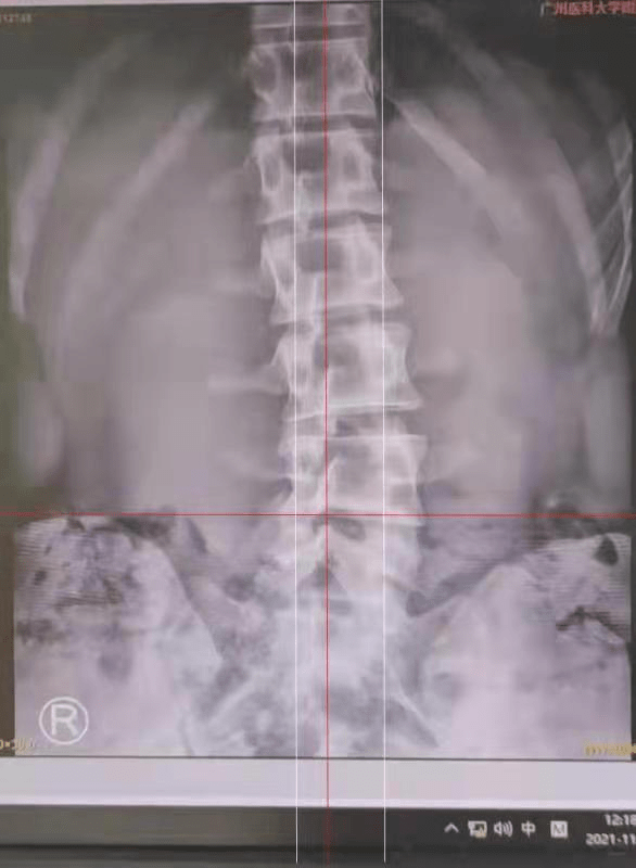 脊柱|18岁高三学子竟腰椎间盘突出！只因忽视了这件事