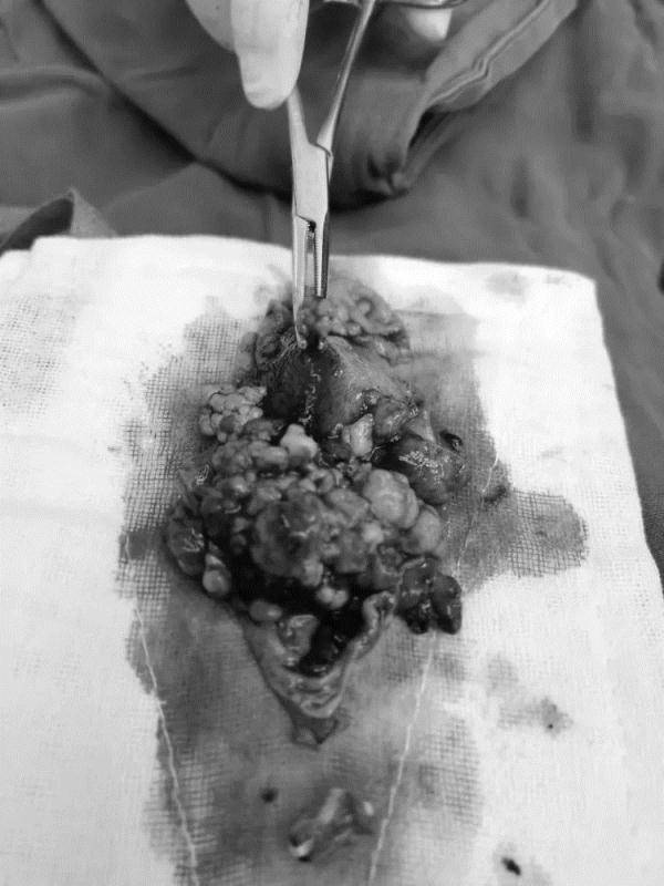 体检|深圳一女子23年从未做过体检，一次就中招！胆囊里密密麻麻全是瘤