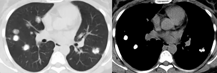 肺转移瘤 vs 十种不典型 ct 表现_钙化