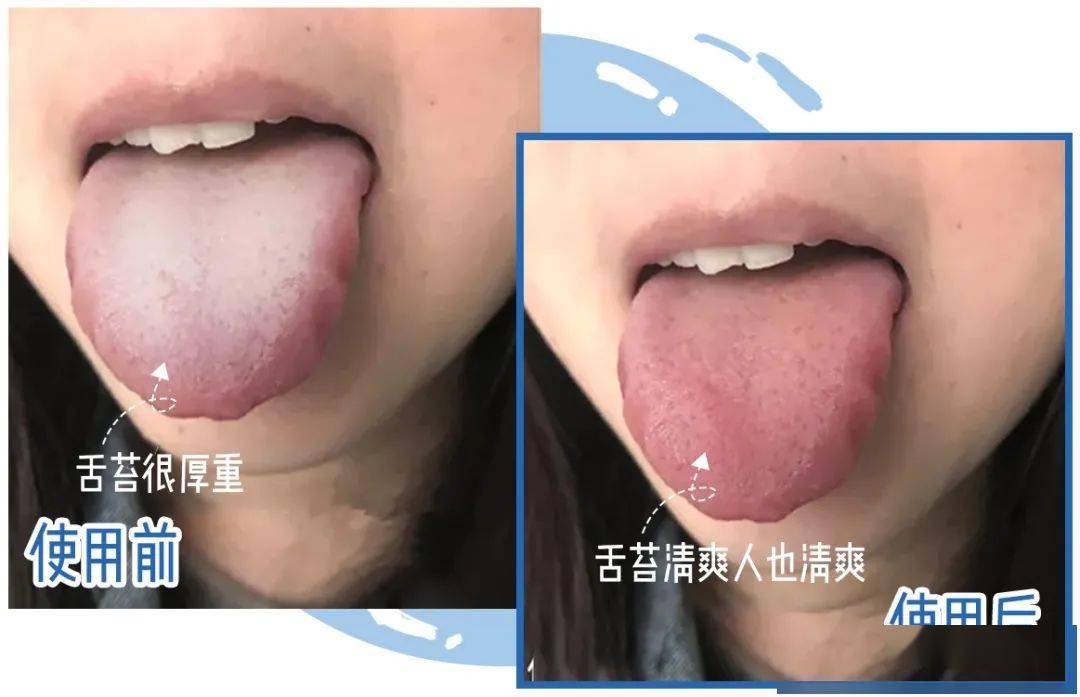 同事小美是个螺蛳粉爱好者,但螺蛳粉对口腔容易溃疡的她来说并不友好.
