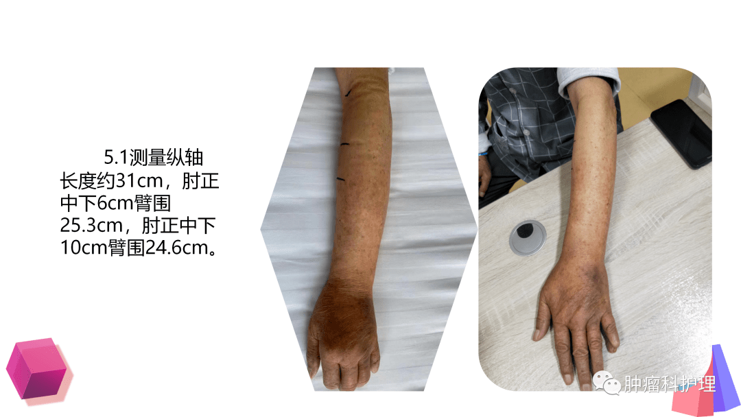 ppt一例脂肪乳外渗案例分析