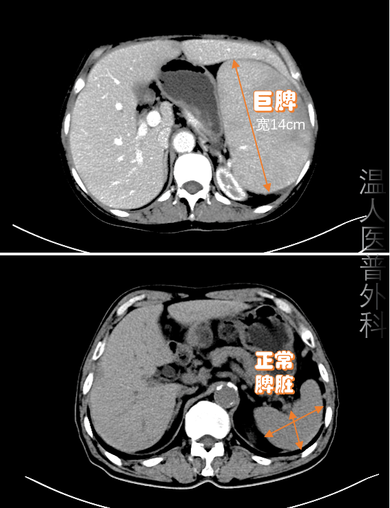 惊呆大妈腹内长10斤重巨脾是常人的35倍