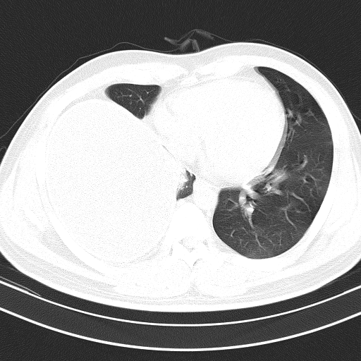 这种大量胸水,千万别做胸腔穿刺_积液