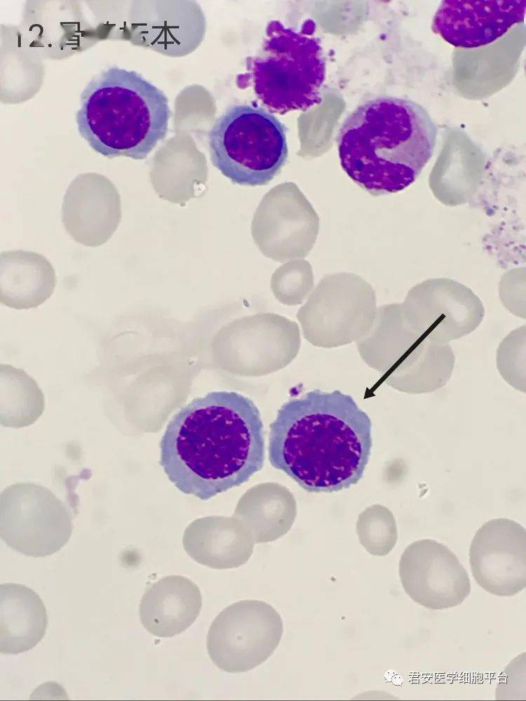 ▼「中幼红细胞」形态特征:胞体呈圆形或椭圆形,胞核圆形,约占细胞的1