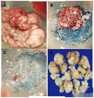 圖文解析結腸息肉的7種切除方法