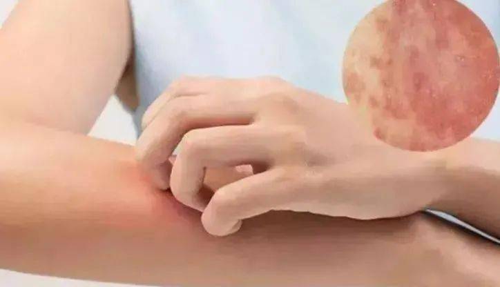 说明书|皮肤凝胶 清疹帮手