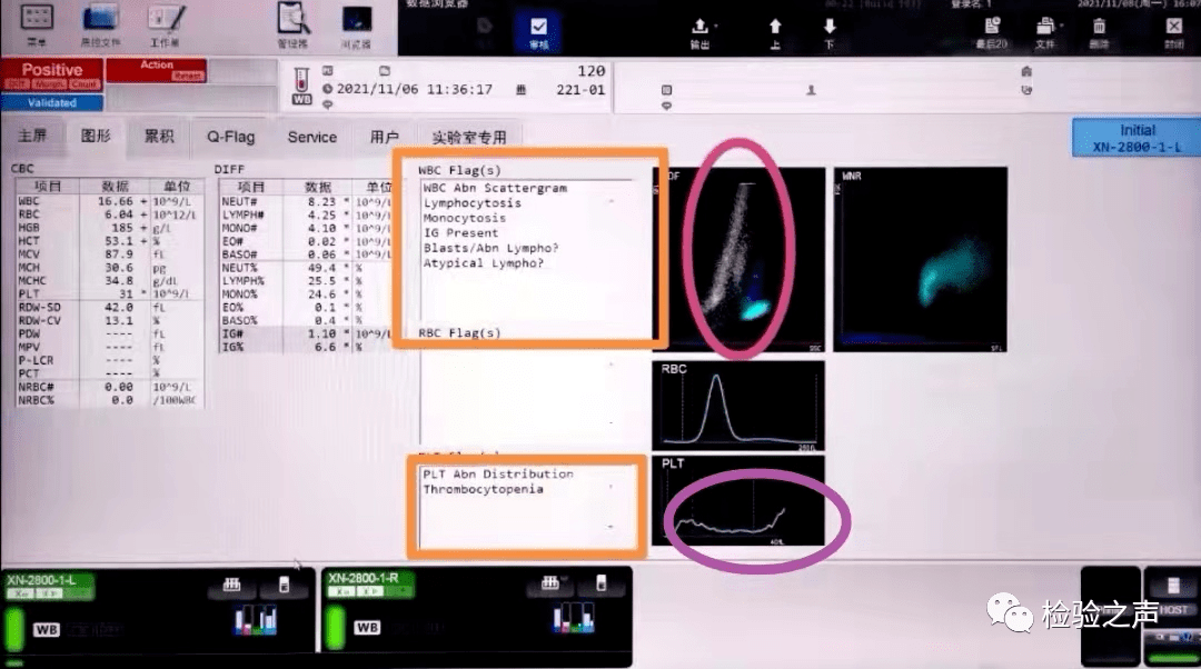 6%(≥15%),血小板計數31×109/l(≤100*10^9/l),觸發血常規復檢規則.