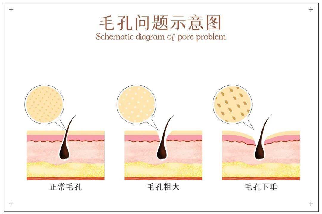 皮膚_角栓_囊蟲