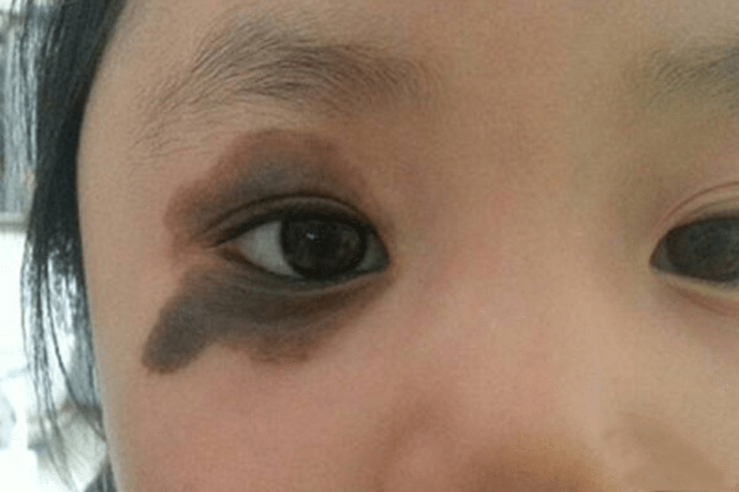 容易影响宝宝健康的胎记  1)咖啡色胎记 这种胎记在生活中很常见