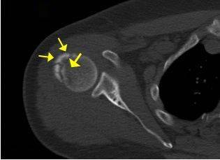 ct掃描示右肩肱骨大結節可見多條發線樣,不規則骨折透亮線(黃色箭頭)