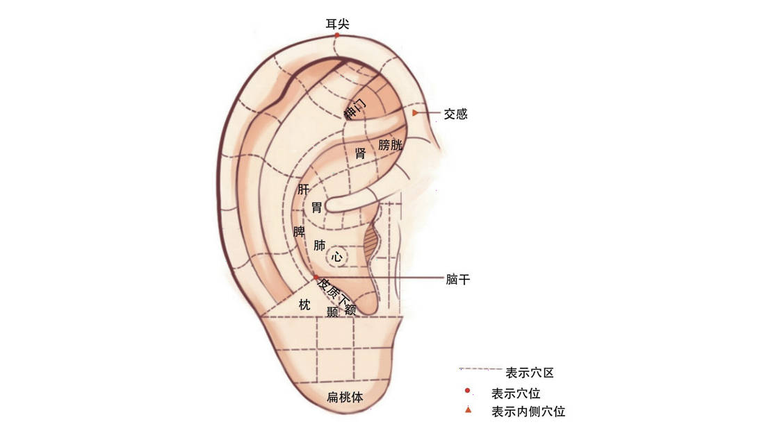 1,耳穴压丸法:主穴取神门,皮质下,枕,风寒加肺,风热加扁桃体,肝阳上亢