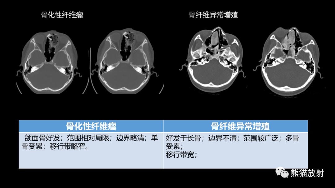 鼻窦癌,颅面骨骨化性纤维瘤你想到了吗?有收获吗?